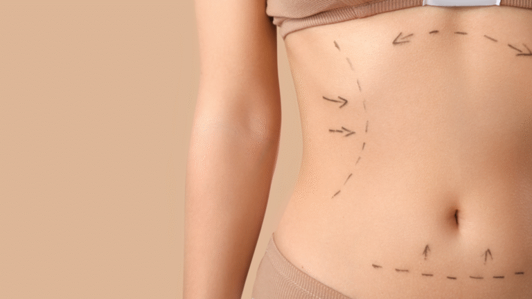 Marcações cirúrgicas no abdômen feminino representando o planejamento para abdominoplastia com o Dr. Alexandre Audi, cirurgião plástico em São Paulo.