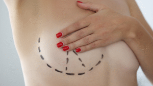 Marcações cirúrgicas na mama feminina indicando o planejamento para mastopexia, realizada pelo Dr. Alexandre Audi, cirurgião plástico em São Paulo.