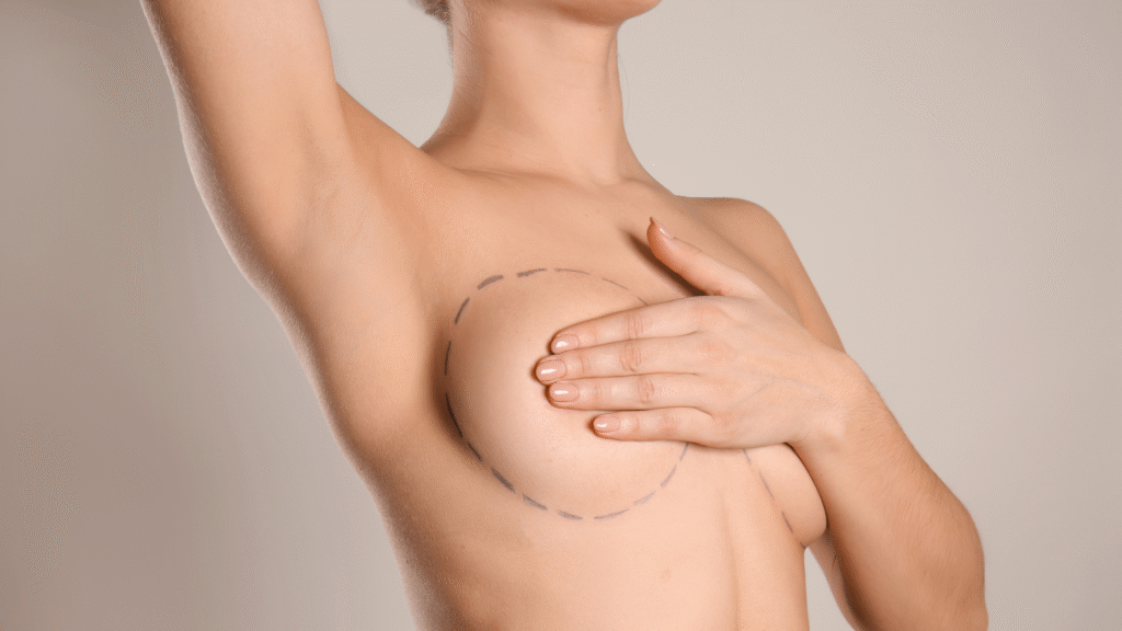 mulher com o braço levantado, com marcação para cirurgia plástica de mamoplastia ou mastopexia