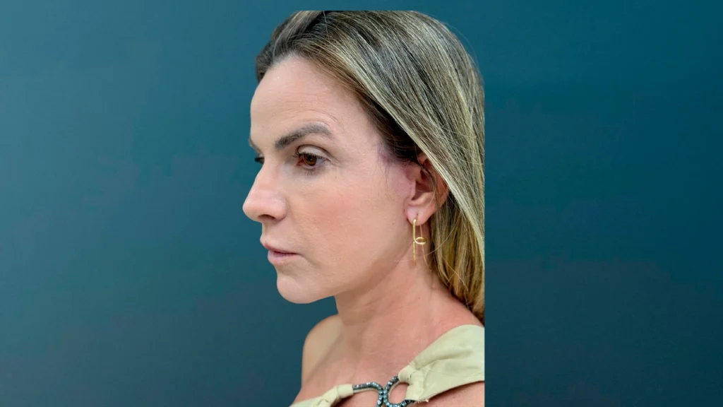 Depois