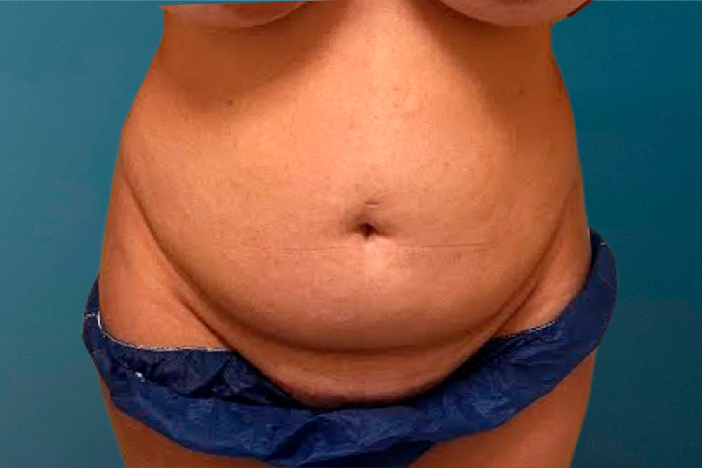 Antes